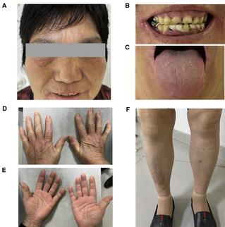 The molecular mechanism of Gaucher disease caused by compound heterozygous mutations in GBA1 gene